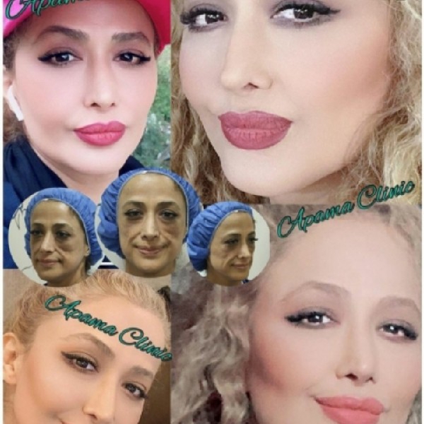 تزریق و تخلیه چربی
