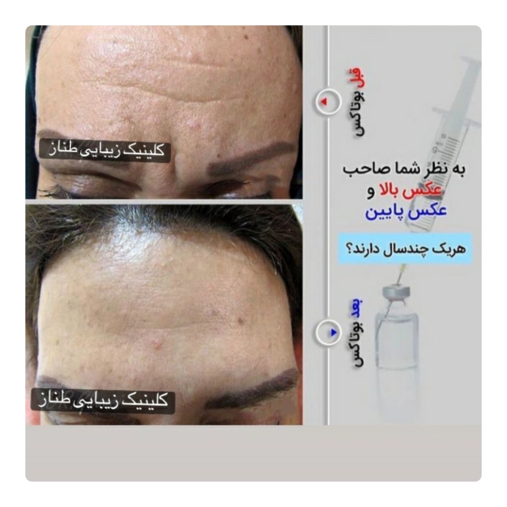 تزریق ژل و بوتاکس