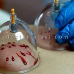 هزینه حجامت رسالت