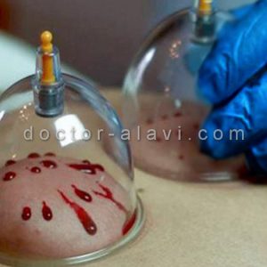 هزینه حجامت رسالت