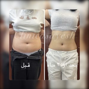 لاغری بدون جراحی با کرایولیپولیز