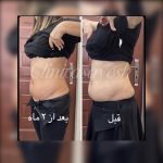 لاغری بدون جراحی با کرایولیپولیز