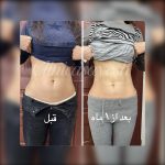لاغری بدون جراحی با کرایولیپولیز