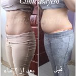 کاهش سایز با کرایولیپولیز
