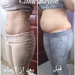 کاهش سایز با کرایولیپولیز