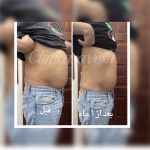 کاهش سایز با کرایولیپولیز